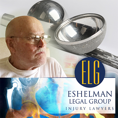 Metal on Metal Hip Replacement Implant, Eshelman Legal Group, Canton Injury Lawyers